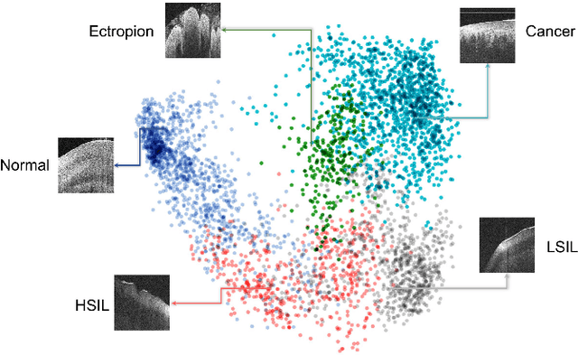 Figure 4 for Computer-Aided Diagnosis of Label-Free 3-D Optical Coherence Microscopy Images of Human Cervical Tissue