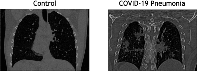 Figure 1 for Probabilistic combination of eigenlungs-based classifiers for COVID-19 diagnosis in chest CT images