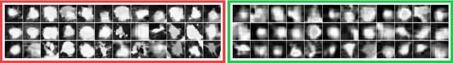 Figure 3 for How to Fool Radiologists with Generative Adversarial Networks? A Visual Turing Test for Lung Cancer Diagnosis