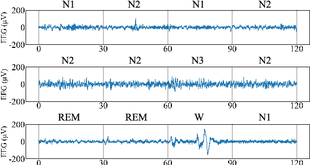 Figure 1 for TransSleep: Transitioning-aware Attention-based Deep Neural Network for Sleep Staging