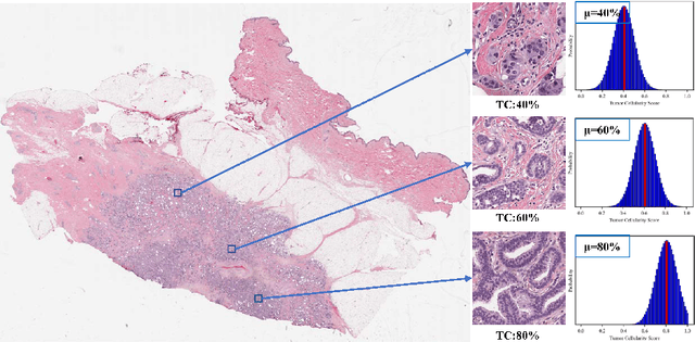 Figure 1 for ULTRA: Uncertainty-aware Label Distribution Learning for Breast Tumor Cellularity Assessment