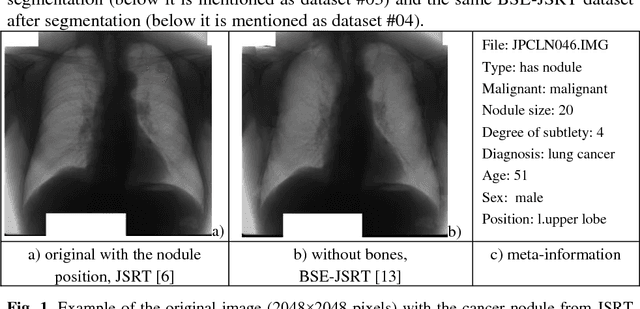 Figure 1 for Deep Learning with Lung Segmentation and Bone Shadow Exclusion Techniques for Chest X-Ray Analysis of Lung Cancer