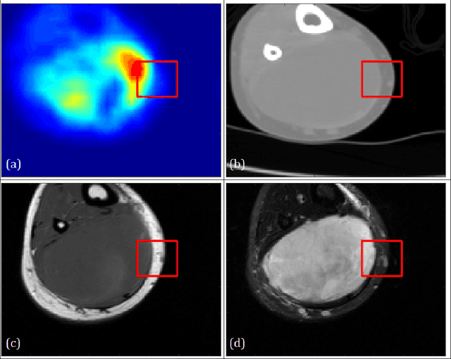 Figure 1 for Medical Image Segmentation Based on Multi-Modal Convolutional Neural Network: Study on Image Fusion Schemes