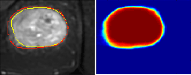 Figure 3 for Medical Image Segmentation Based on Multi-Modal Convolutional Neural Network: Study on Image Fusion Schemes
