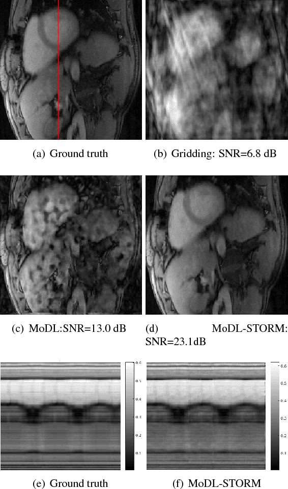 Figure 3 for Model-based free-breathing cardiac MRI reconstruction using deep learned \& STORM priors: MoDL-STORM