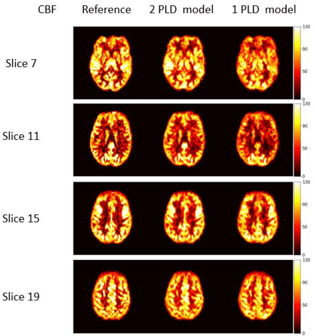 Figure 3 for Acceleration of cerebral blood flow and arterial transit time maps estimation from multiple post-labeling delay arterial spin-labeled MRI via deep learning