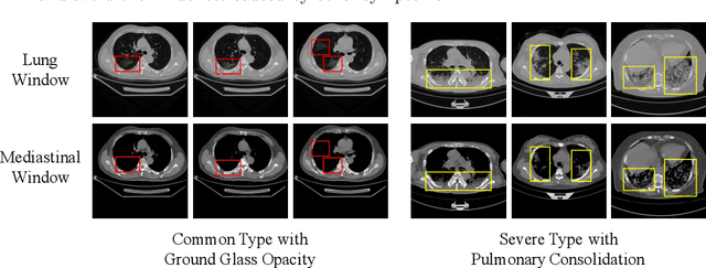 Figure 3 for Dual Windows Are Significant: Learning from Mediastinal Window and Focusing on Lung Window