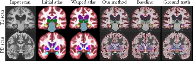Figure 3 for Unsupervised deep learning for Bayesian brain MRI segmentation