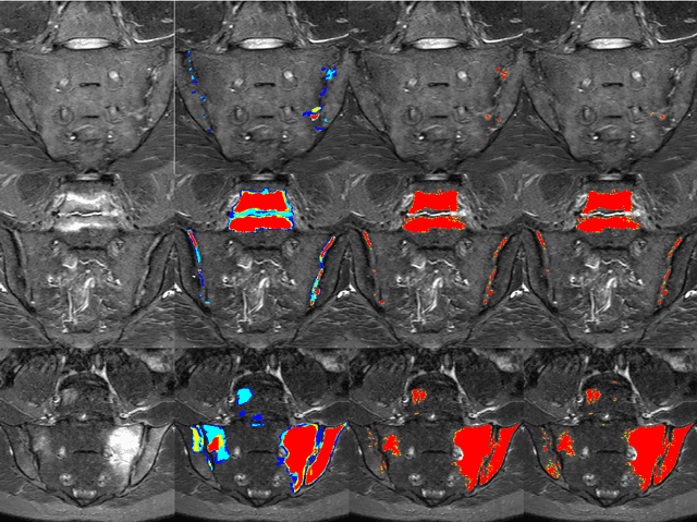 Figure 3 for Towards Deep Learning-assisted Quantification of Inflammation in Spondyloarthritis: Intensity-based Lesion Segmentation