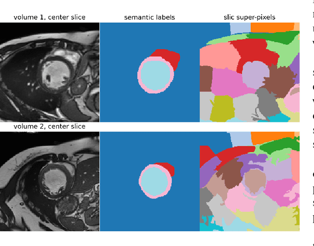 Figure 1 for Local contrastive loss with pseudo-label based self-training for semi-supervised medical image segmentation