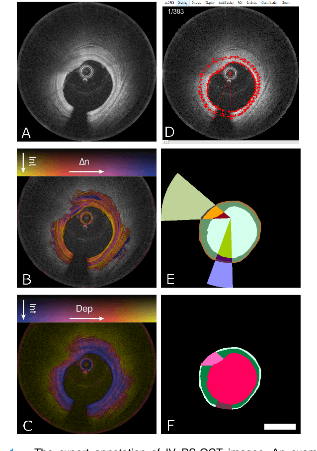 Figure 1 for Segmentation of Anatomical Layers and Artifacts in Intravascular Polarization Sensitive Optical Coherence Tomography Using Attending Physician and Boundary Cardinality Lost Terms