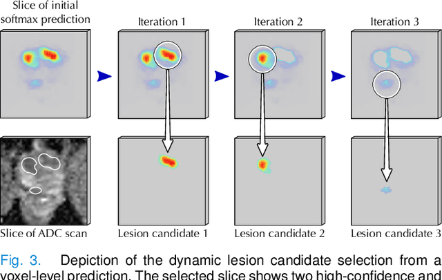 Figure 3 for Report-Guided Automatic Lesion Annotation for Deep Learning-Based Prostate Cancer Detection in bpMRI