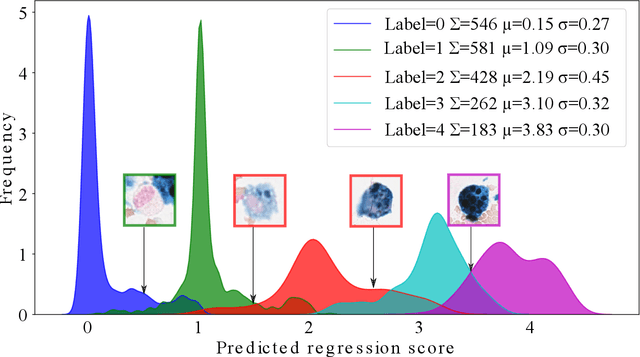 Figure 3 for Deep Learning-Based Quantification of Pulmonary Hemosiderophages in Cytology Slides
