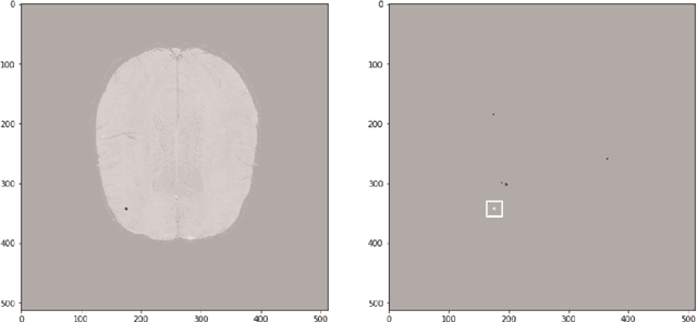 Figure 4 for MixMicrobleed: Multi-stage detection and segmentation of cerebral microbleeds