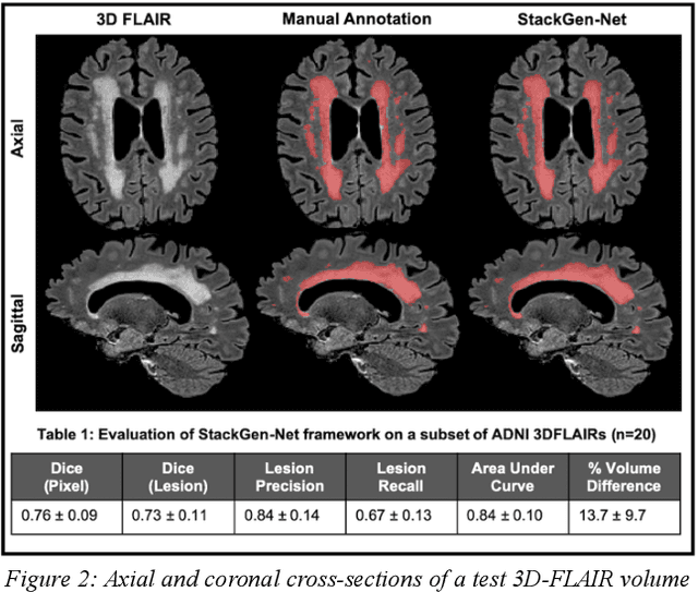 Figure 2 for White matter hyperintensities volume and cognition: Assessment of a deep learning based lesion detection and quantification algorithm on the Alzheimers Disease Neuroimaging Initiative