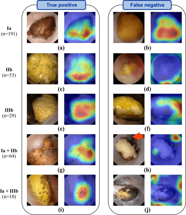 Figure 2 for Towards Automatic Recognition of Pure & Mixed Stones using Intraoperative Endoscopic Digital Images