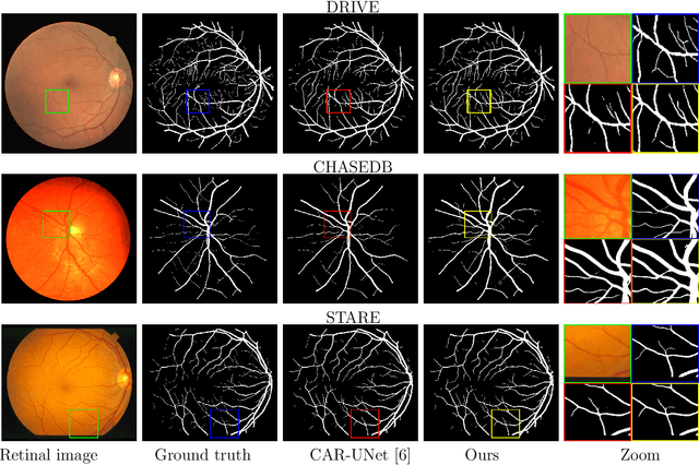 Figure 2 for DR-VNet: Retinal Vessel Segmentation via Dense Residual UNet