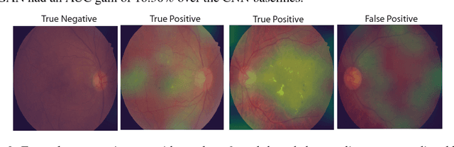 Figure 4 for Semi-Supervised Deep Learning for Abnormality Classification in Retinal Images