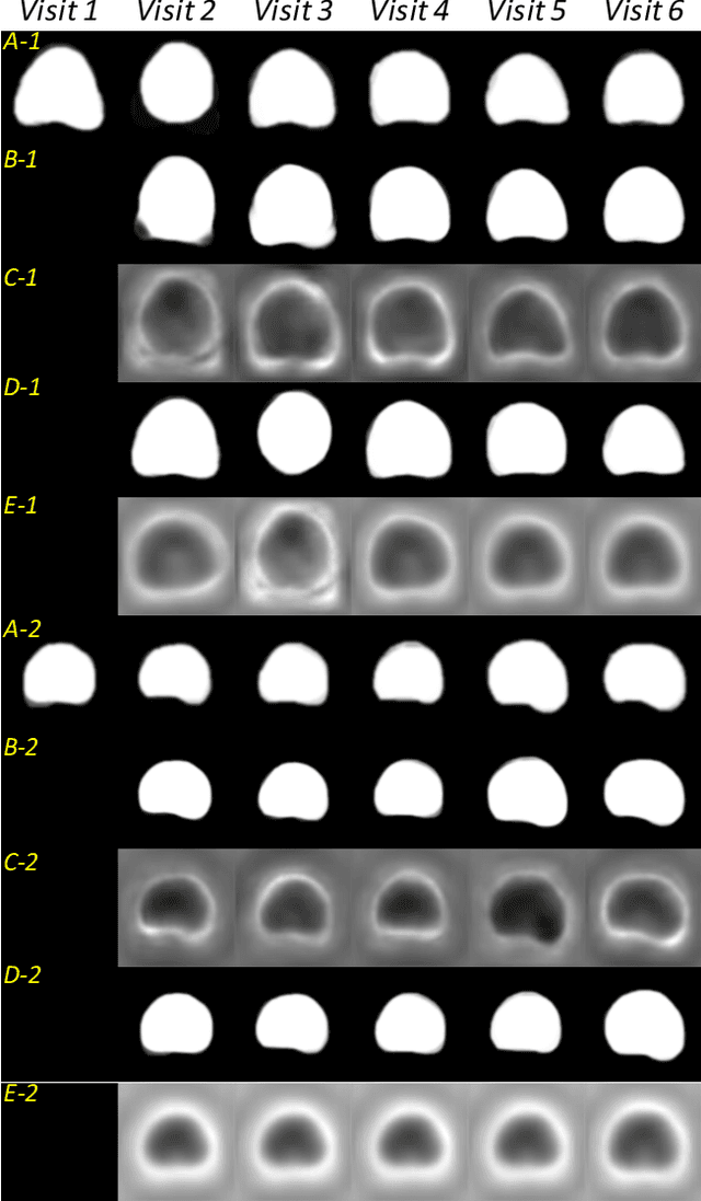 Figure 4 for Morphological Change Forecasting for Prostate Glands using Feature-based Registration and Kernel Density Extrapolation