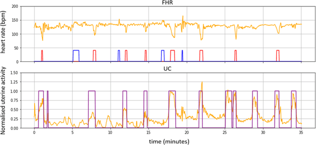 Figure 1 for Classification of fetal compromise during labour: signal processing and feature engineering of the cardiotocograph