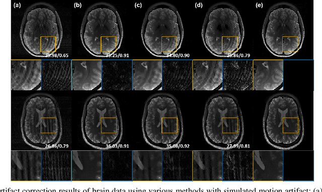 Figure 4 for Unsupervised MR Motion Artifact Deep Learning using Outlier-Rejecting Bootstrap Aggregation