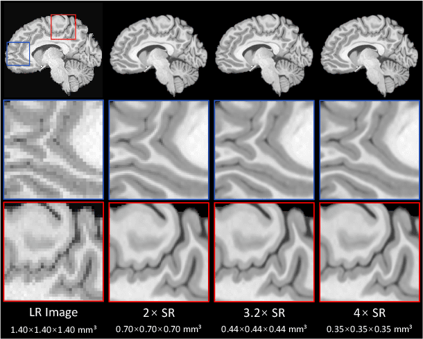 Figure 1 for An Arbitrary Scale Super-Resolution Approach for 3-Dimensional Magnetic Resonance Image using Implicit Neural Representation
