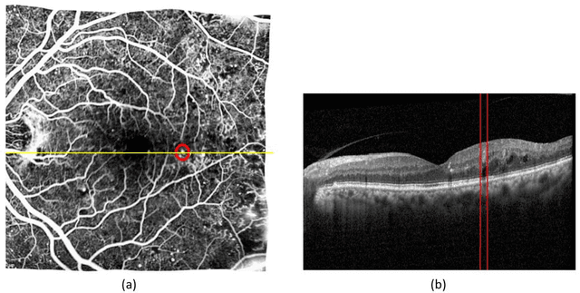 Figure 2 for Automatic Detection of Microaneurysms in OCT Images Using Bag of Features