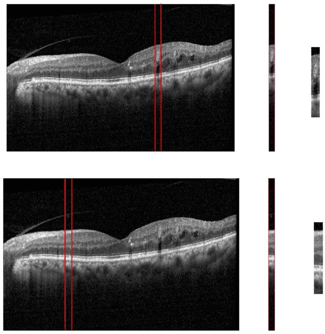 Figure 3 for Automatic Detection of Microaneurysms in OCT Images Using Bag of Features