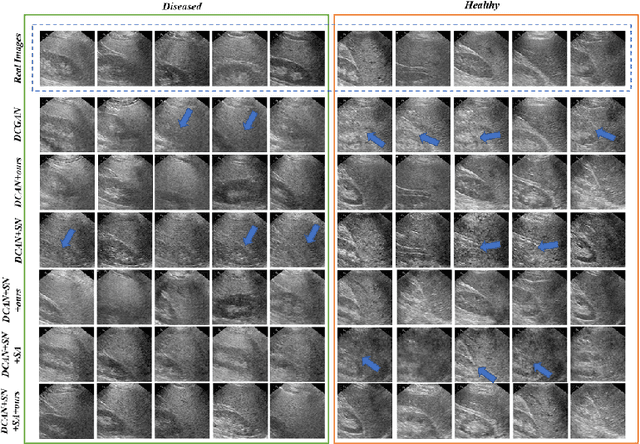 Figure 3 for Realistic Ultrasound Image Synthesis for Improved Classification of Liver Disease