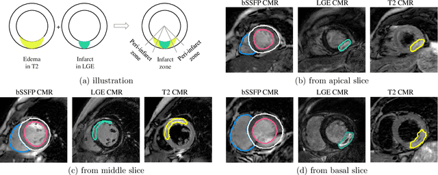 Figure 4 for MyoPS: A Benchmark of Myocardial Pathology Segmentation Combining Three-Sequence Cardiac Magnetic Resonance Images