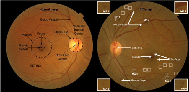 Figure 1 for A comprehensive survey on computer-aided diagnostic systems in diabetic retinopathy screening