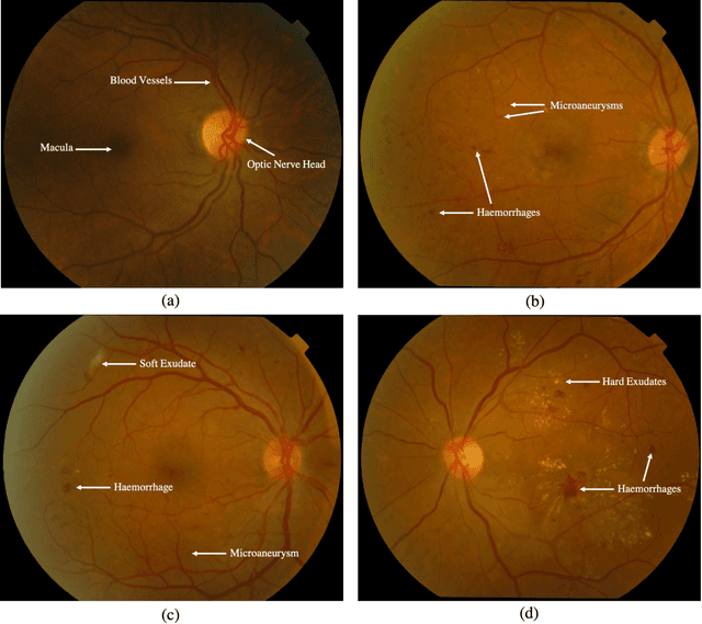 Figure 3 for A comprehensive survey on computer-aided diagnostic systems in diabetic retinopathy screening