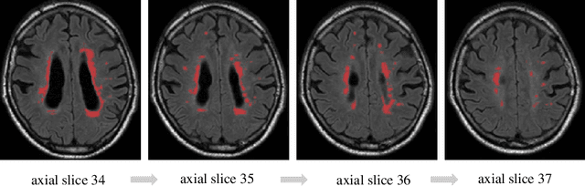 Figure 1 for Multi-Scale Convolutional-Stack Aggregation for Robust White Matter Hyperintensities Segmentation