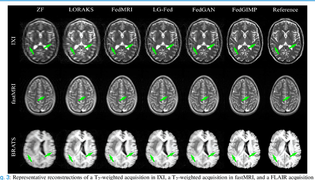 Figure 3 for Federated Learning of Generative Image Priors for MRI Reconstruction