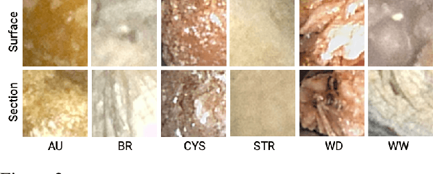 Figure 3 for Interpretable Deep Learning Classifier by Detection of Prototypical Parts on Kidney Stones Images