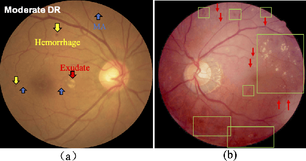 Figure 1 for Robust Collaborative Learning of Patch-level and Image-level Annotations for Diabetic Retinopathy Grading from Fundus Image
