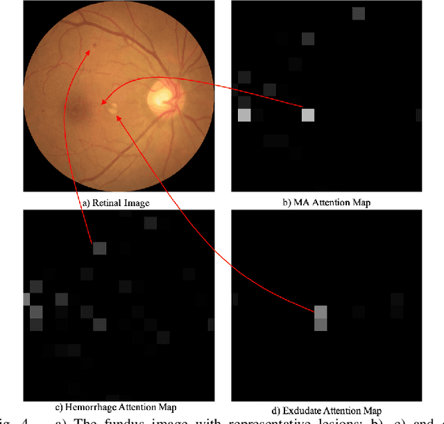Figure 4 for Robust Collaborative Learning of Patch-level and Image-level Annotations for Diabetic Retinopathy Grading from Fundus Image