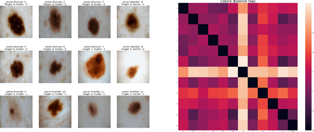 Figure 1 for A Clinically Inspired Approach for Melanoma classification