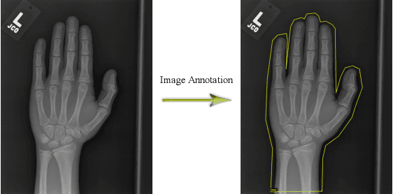 Figure 1 for Ridge Regression Neural Network for Pediatric Bone Age Assessment