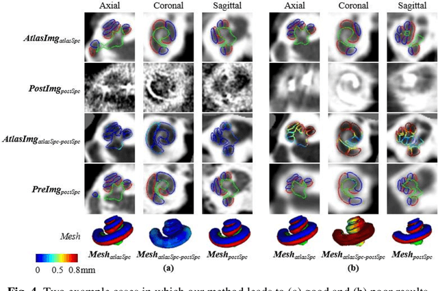 Figure 4 for Atlas-Based Segmentation of Intracochlear Anatomy in Metal Artifact Affected CT Images of the Ear with Co-trained Deep Neural Networks