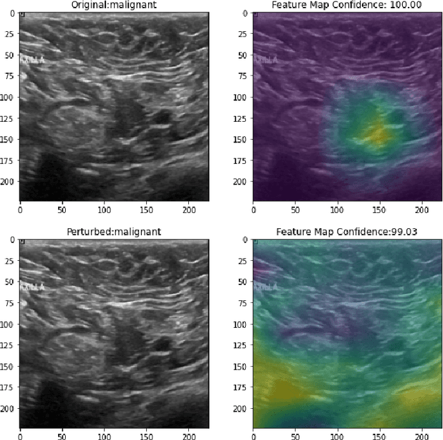 Figure 2 for Explainable AI and susceptibility to adversarial attacks: a case study in classification of breast ultrasound images