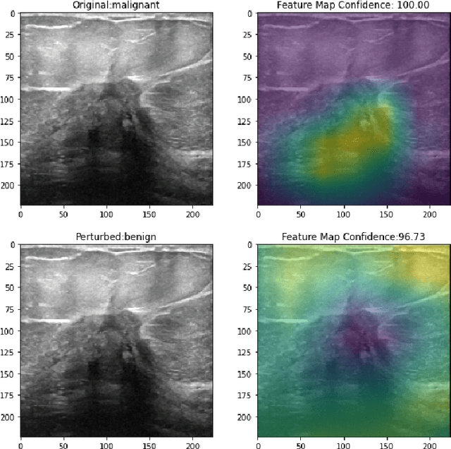Figure 3 for Explainable AI and susceptibility to adversarial attacks: a case study in classification of breast ultrasound images