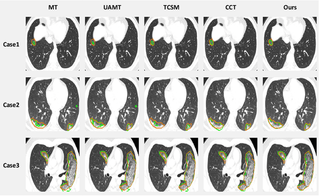 Figure 4 for Dual-Consistency Semi-Supervised Learning with Uncertainty Quantification for COVID-19 Lesion Segmentation from CT Images