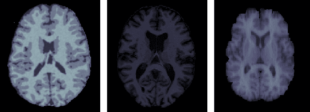 Figure 1 for A cross-center smoothness prior for variational Bayesian brain tissue segmentation