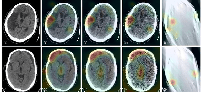 Figure 3 for Assessing Robustness to Noise: Low-Cost Head CT Triage