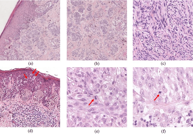 Figure 1 for An Attention-based Weakly Supervised framework for Spitzoid Melanocytic Lesion Diagnosis in WSI