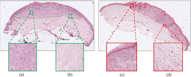 Figure 3 for An Attention-based Weakly Supervised framework for Spitzoid Melanocytic Lesion Diagnosis in WSI