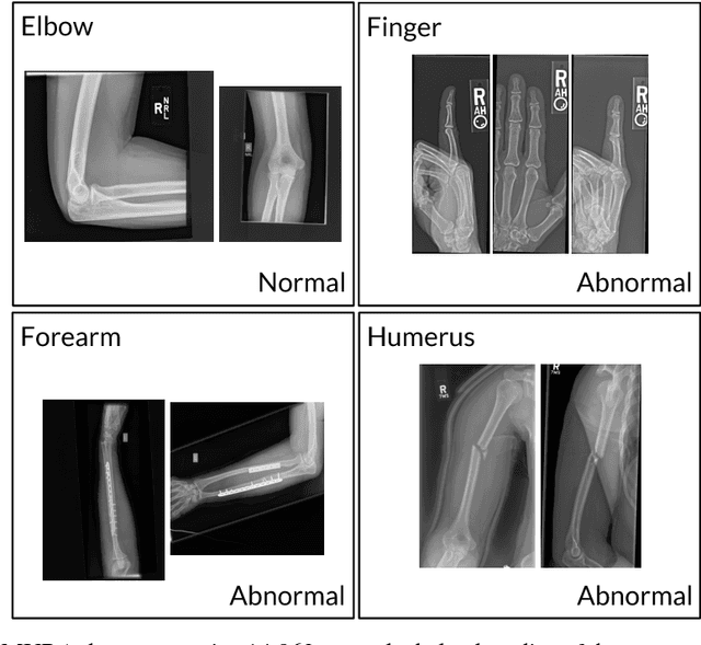 Figure 1 for MURA: Large Dataset for Abnormality Detection in Musculoskeletal Radiographs