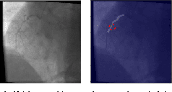Figure 3 for Automated Characterization of Stenosis in Invasive Coronary Angiography Images with Convolutional Neural Networks