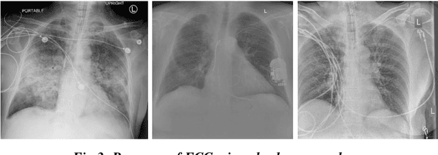 Figure 2 for Classification of COVID-19 on chest X-Ray images using Deep Learning model with Histogram Equalization and Lungs Segmentation